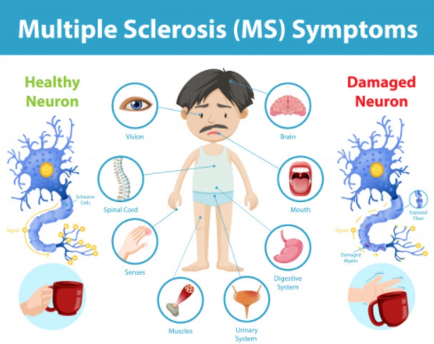 Multiple Sclerosis Symptoms