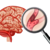 ischemic_stroke-removebg-preview ischemic_stroke-removebg-preview